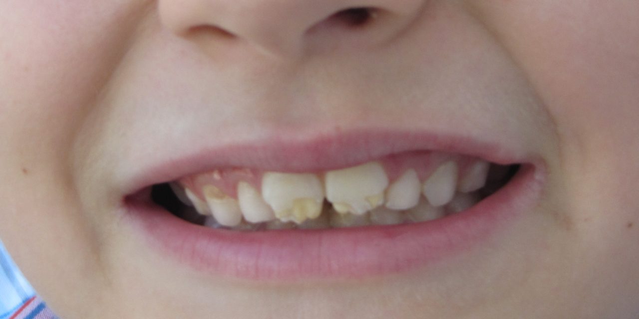 Celiachia e salute orale: gli effetti sullo smalto dentale