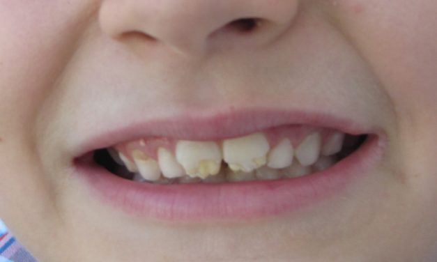 Celiachia e salute orale: gli effetti sullo smalto dentale