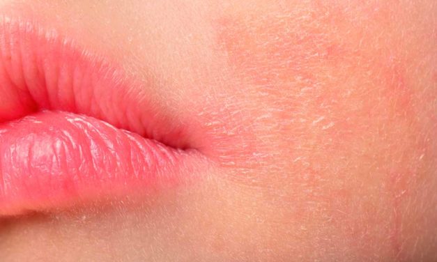 Dermatite erpetiforme, quali sono le cause
