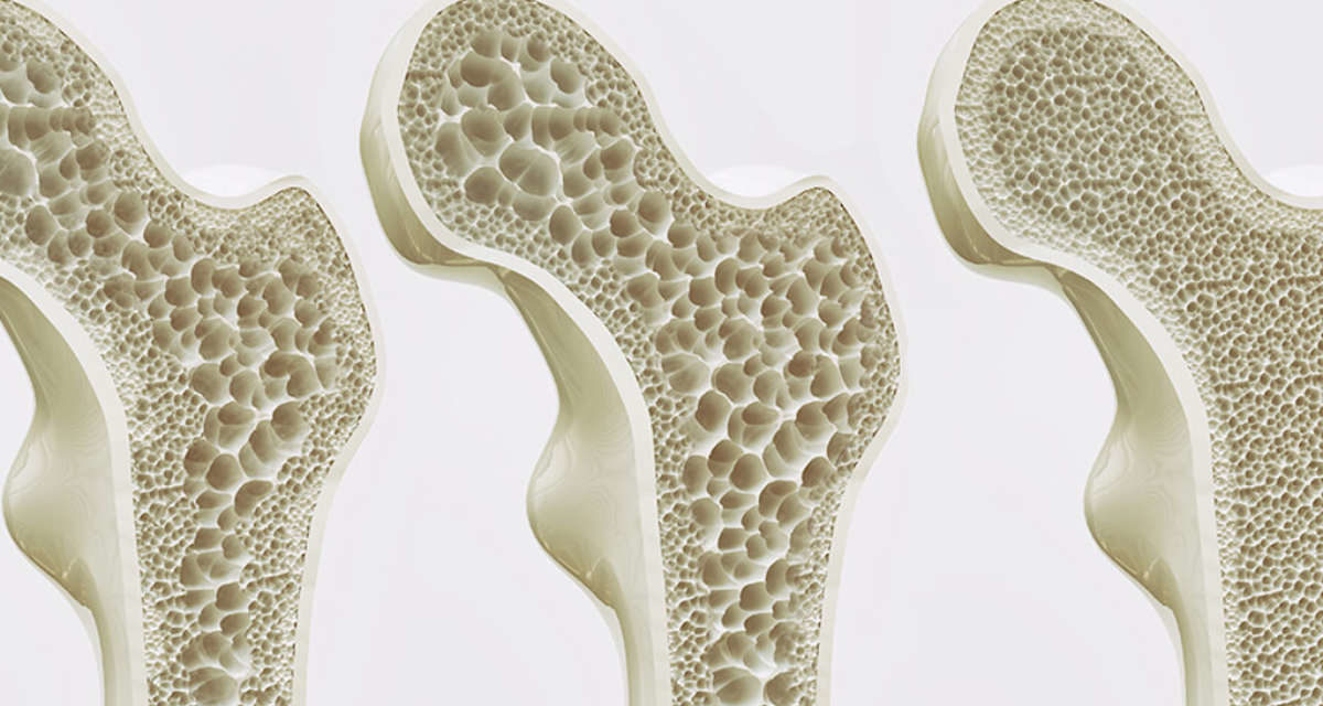 Con la celiachia rischio più alto di fratture osteoporotiche maggiori