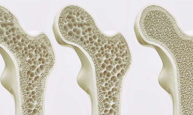 Con la celiachia rischio più alto di fratture osteoporotiche maggiori